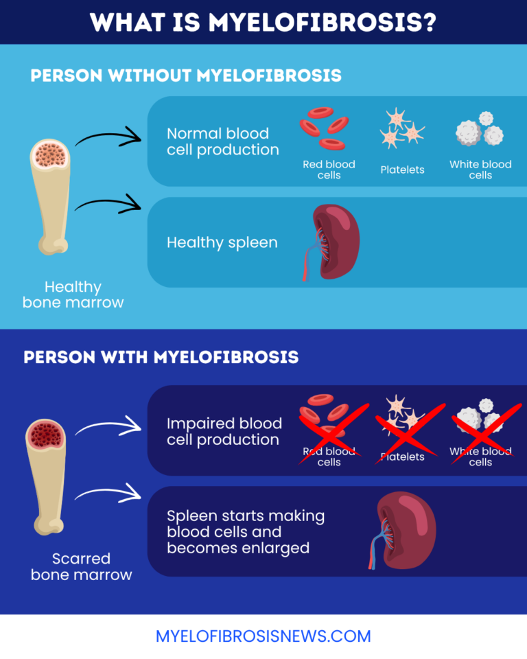 Myelofibrosis overview | Myelofibrosis News